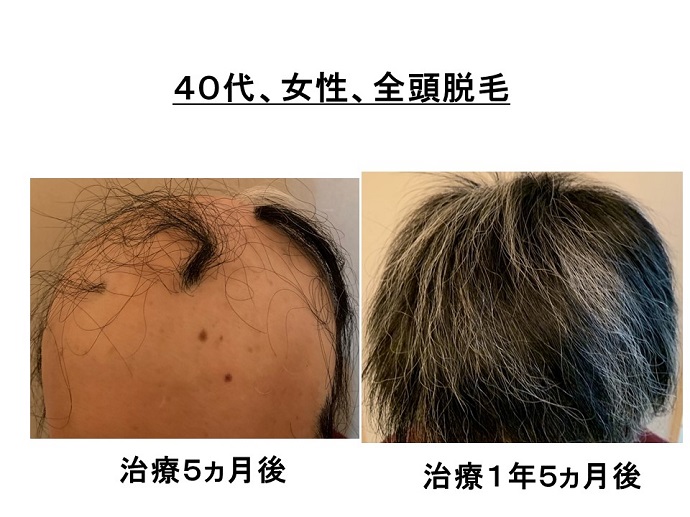 円形脱毛症　病院